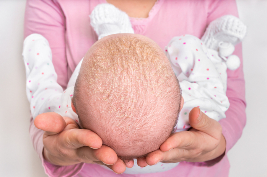 Croûte de lait : quels produits utiliser pour s’en débarrasser ?
